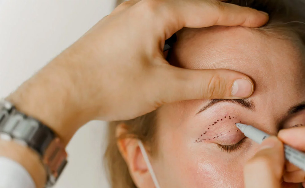 deroulement blepharoplastie