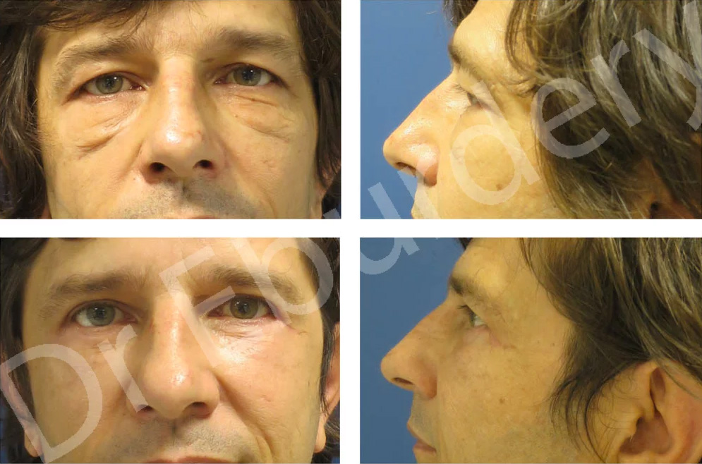Blépharoplastie