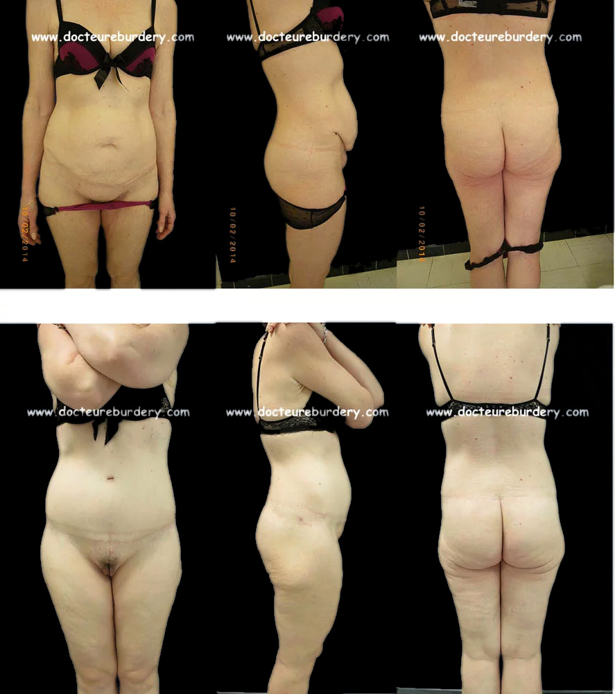 Photos - bodylift - Patiente 1