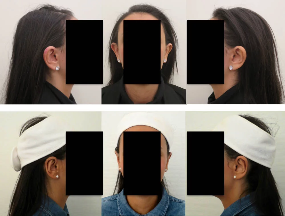 otoplastie - Patiente 1