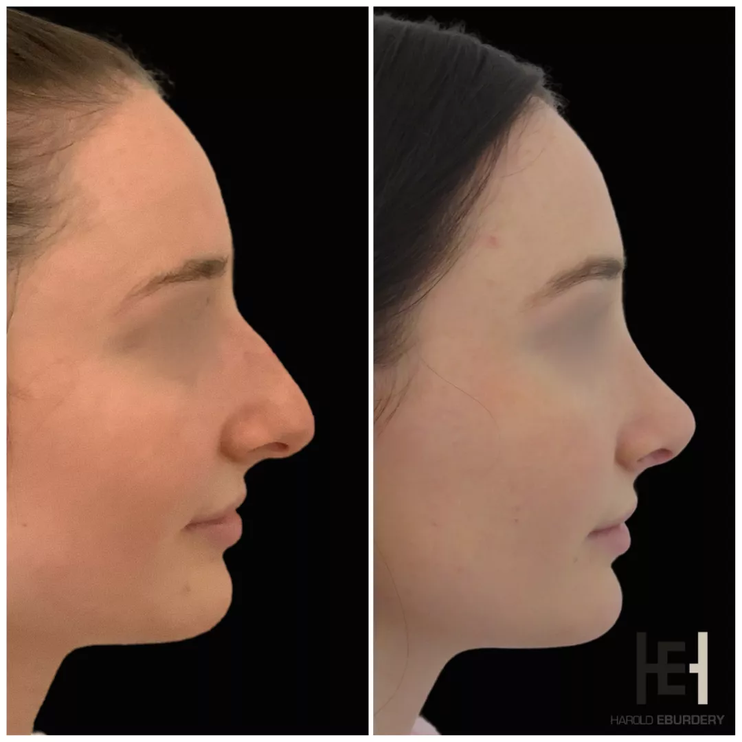 Rhinoplastie - Patiente 2
