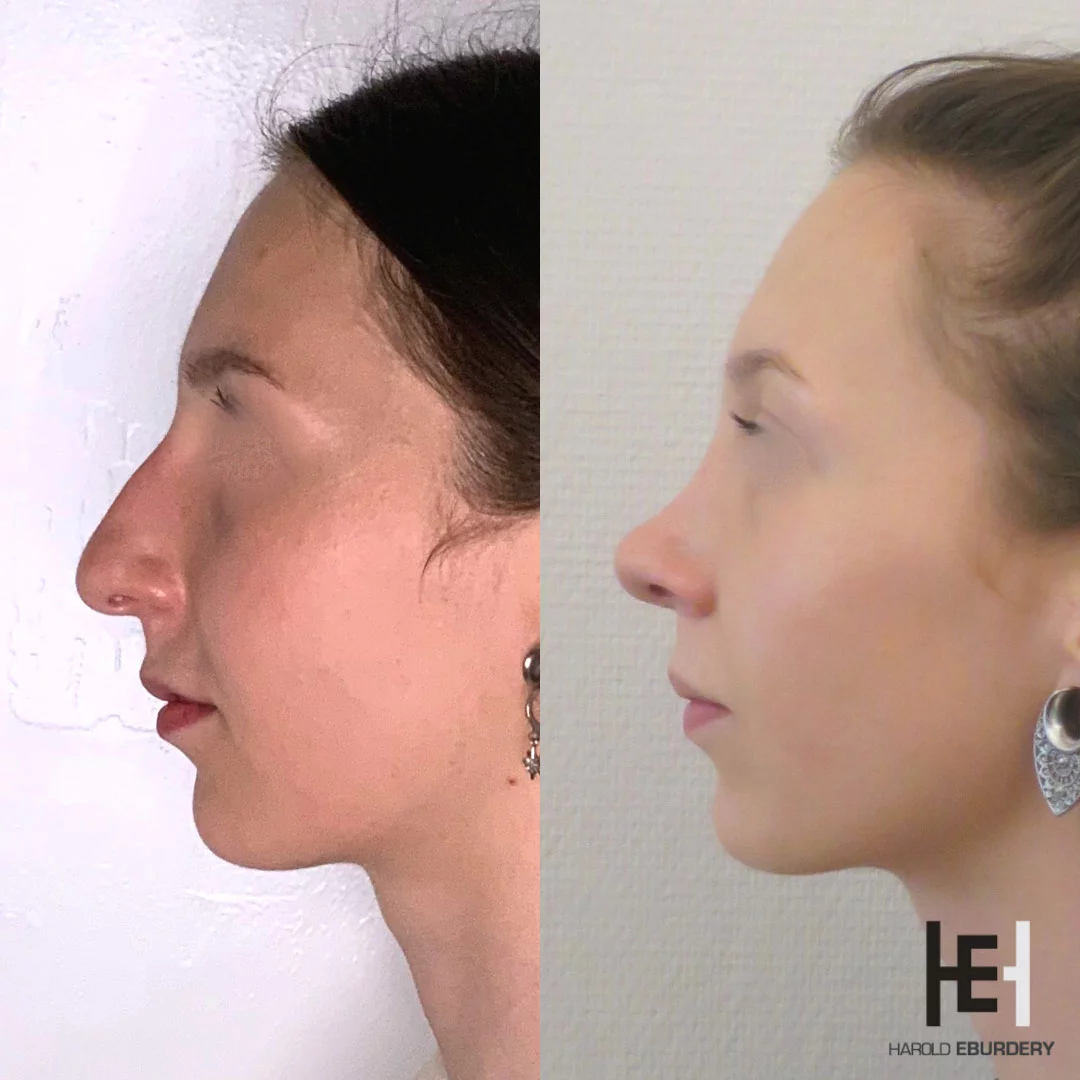 Rhinoplastie - Patiente 3