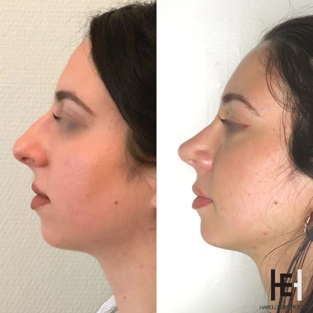 Rhinoplastie préservation - Patiente 3