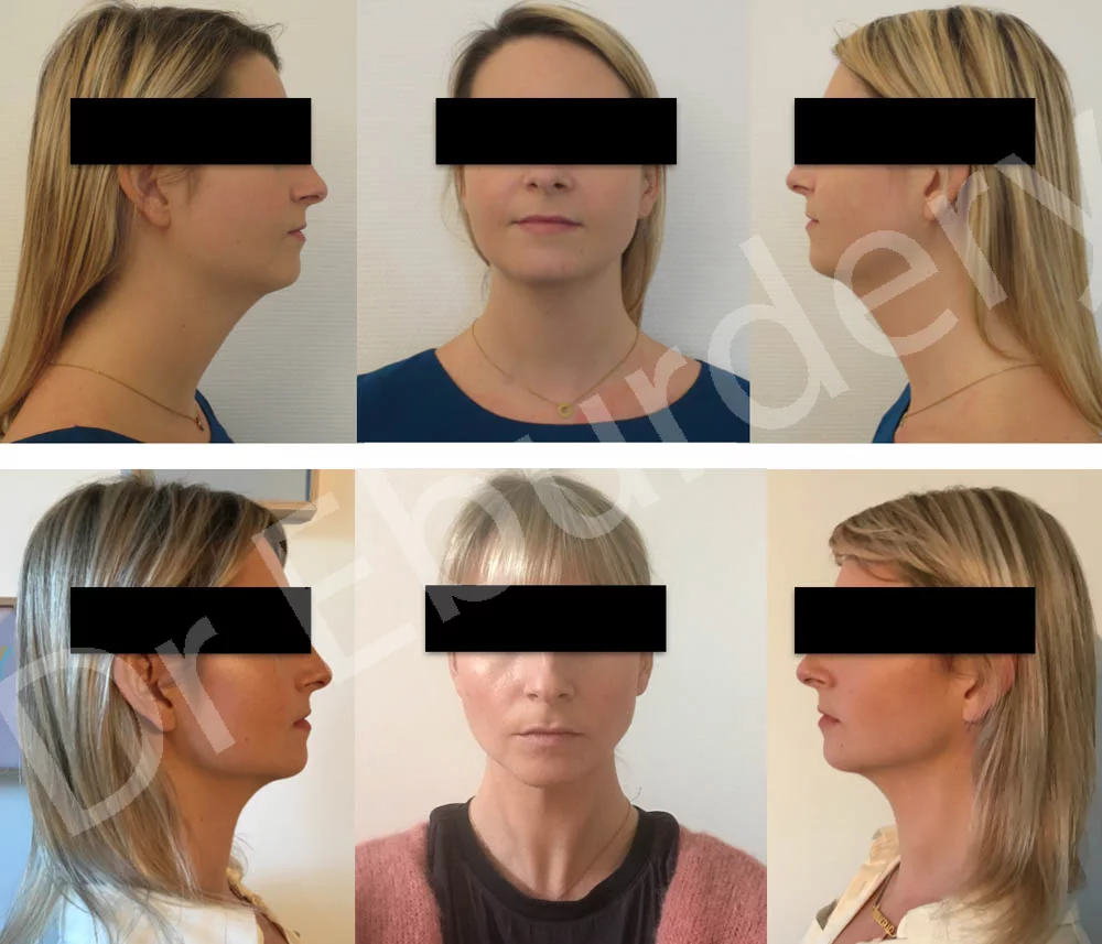 lipofilling facial - Patient 1