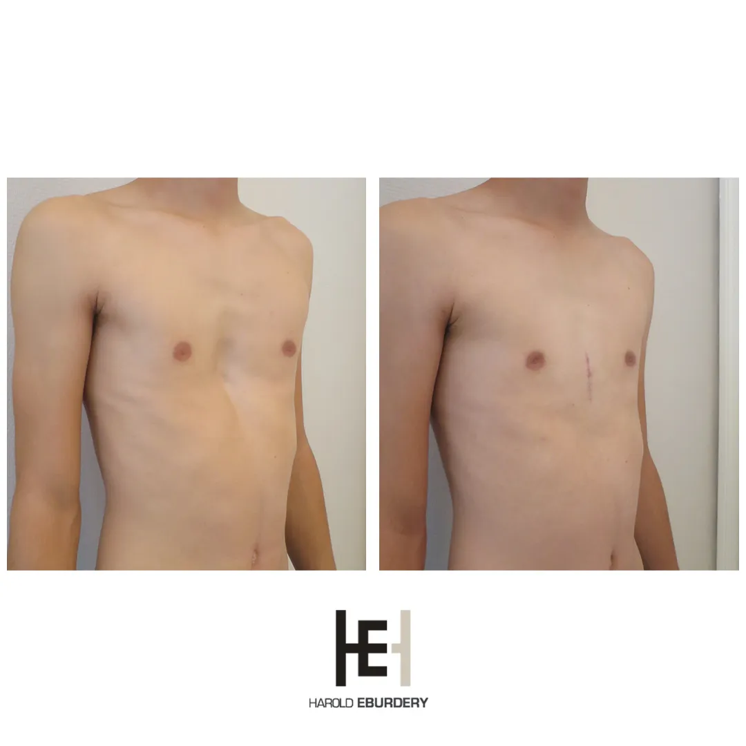 Pectus - Patient 4