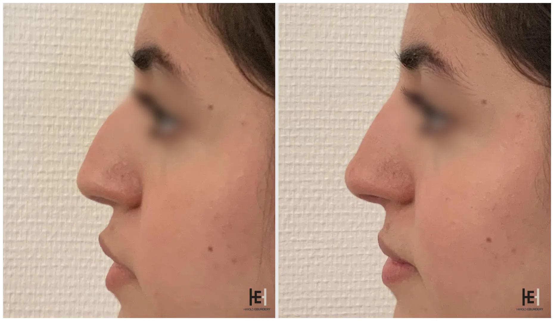 Rhinoplastie médicale - Patiente 1