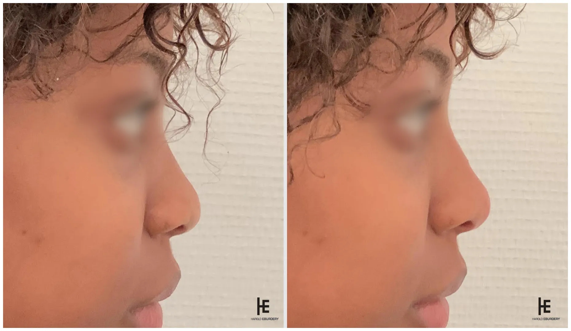 Rhinoplastie médicale - Patiente 2