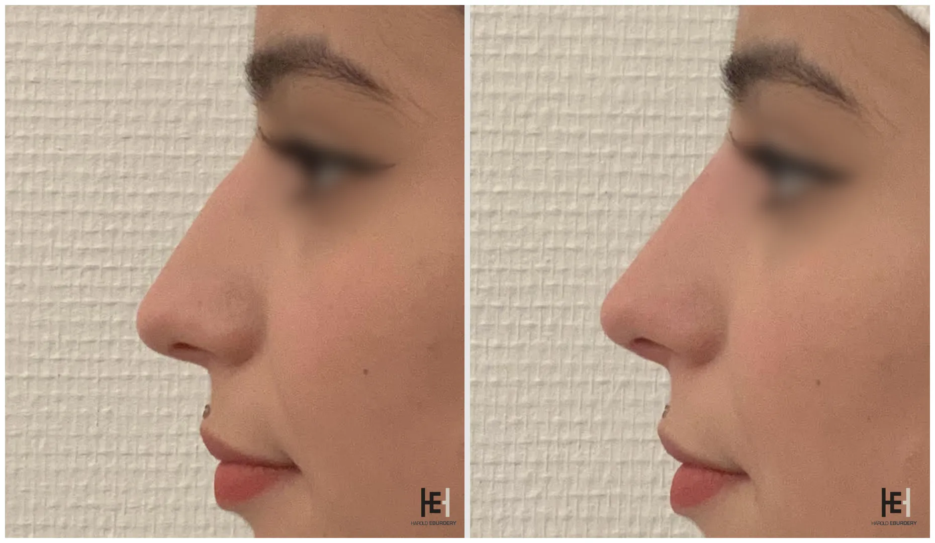 Rhinoplastie médicale - Patiente 3