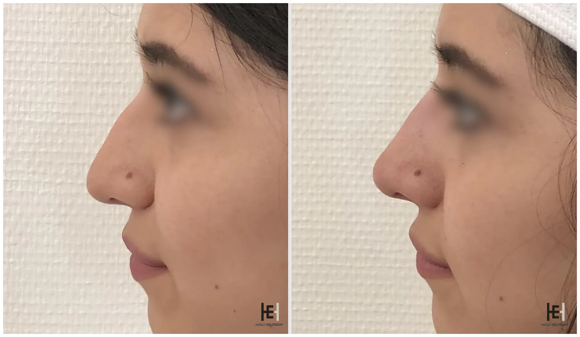 Rhinoplastie médicale - Patiente 4