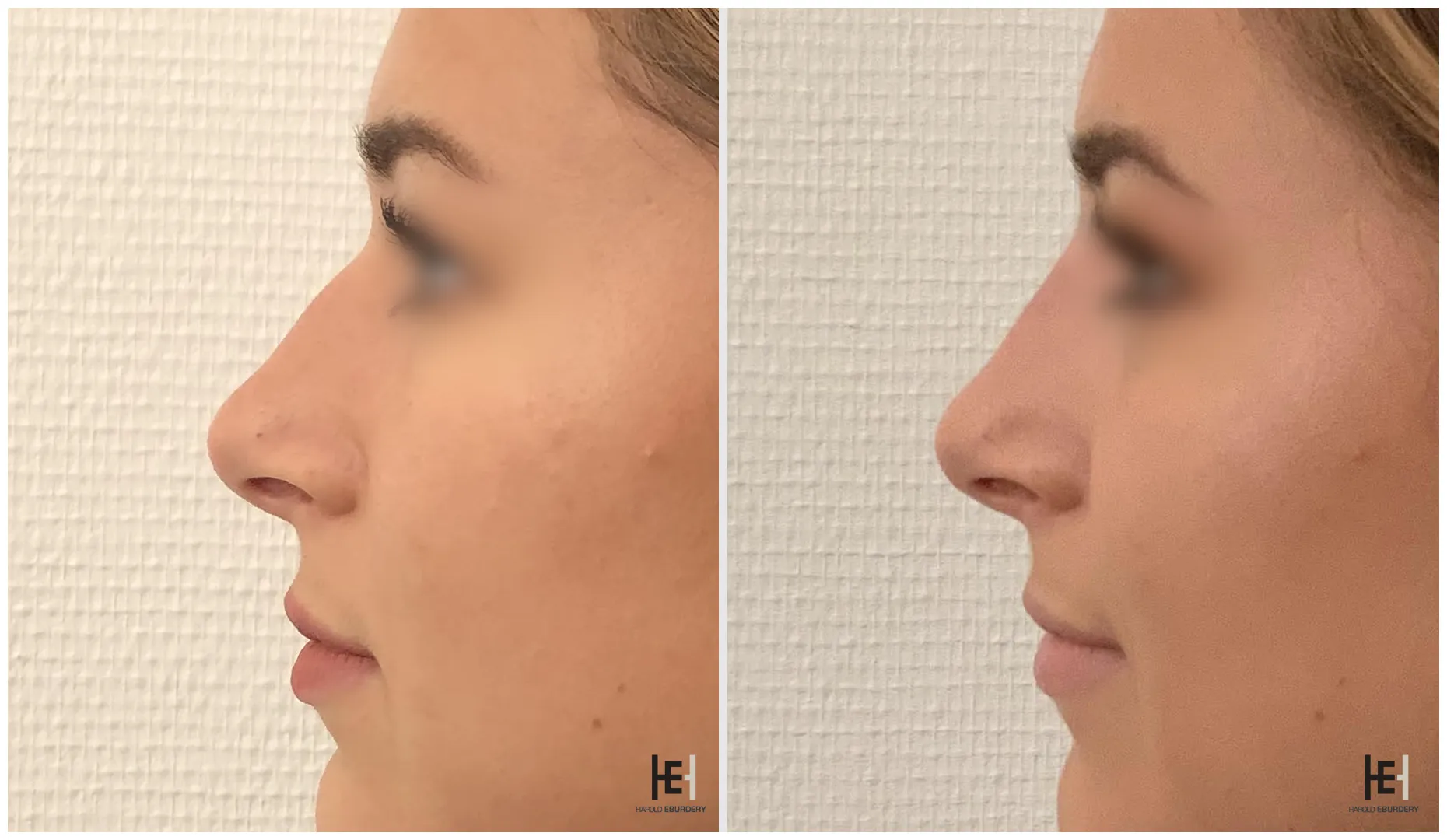 Rhinoplastie médicale - Patiente 5