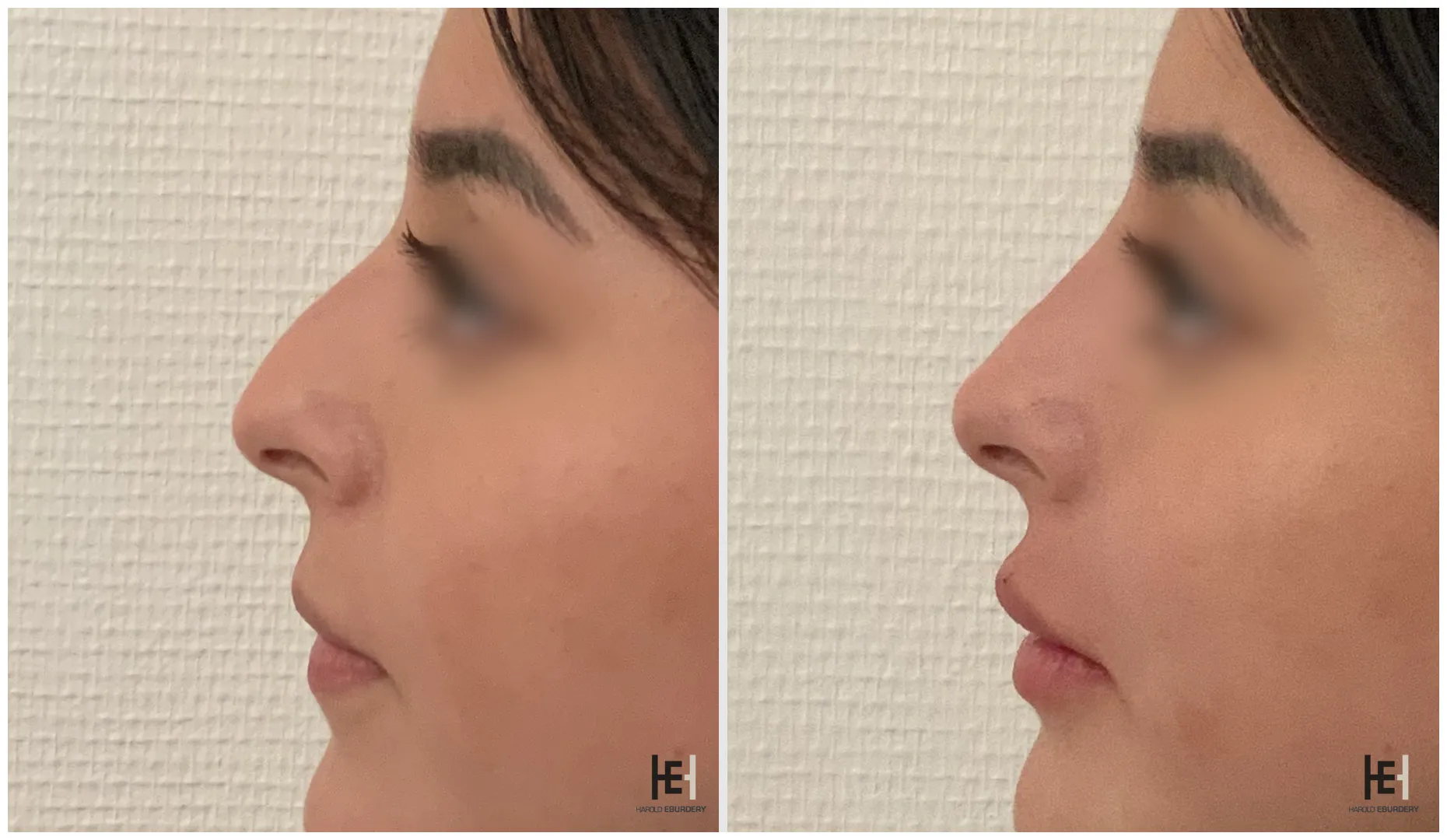 Rhinoplastie médicale - Patiente 6