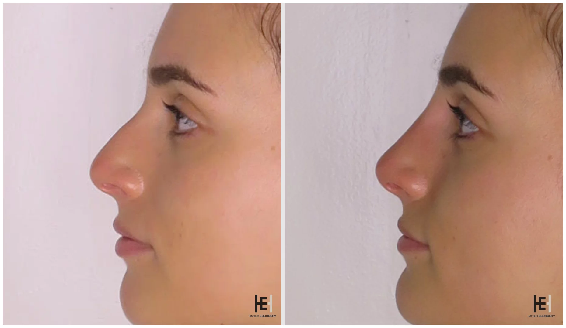 Rhinoplastie médicale - Patiente 7