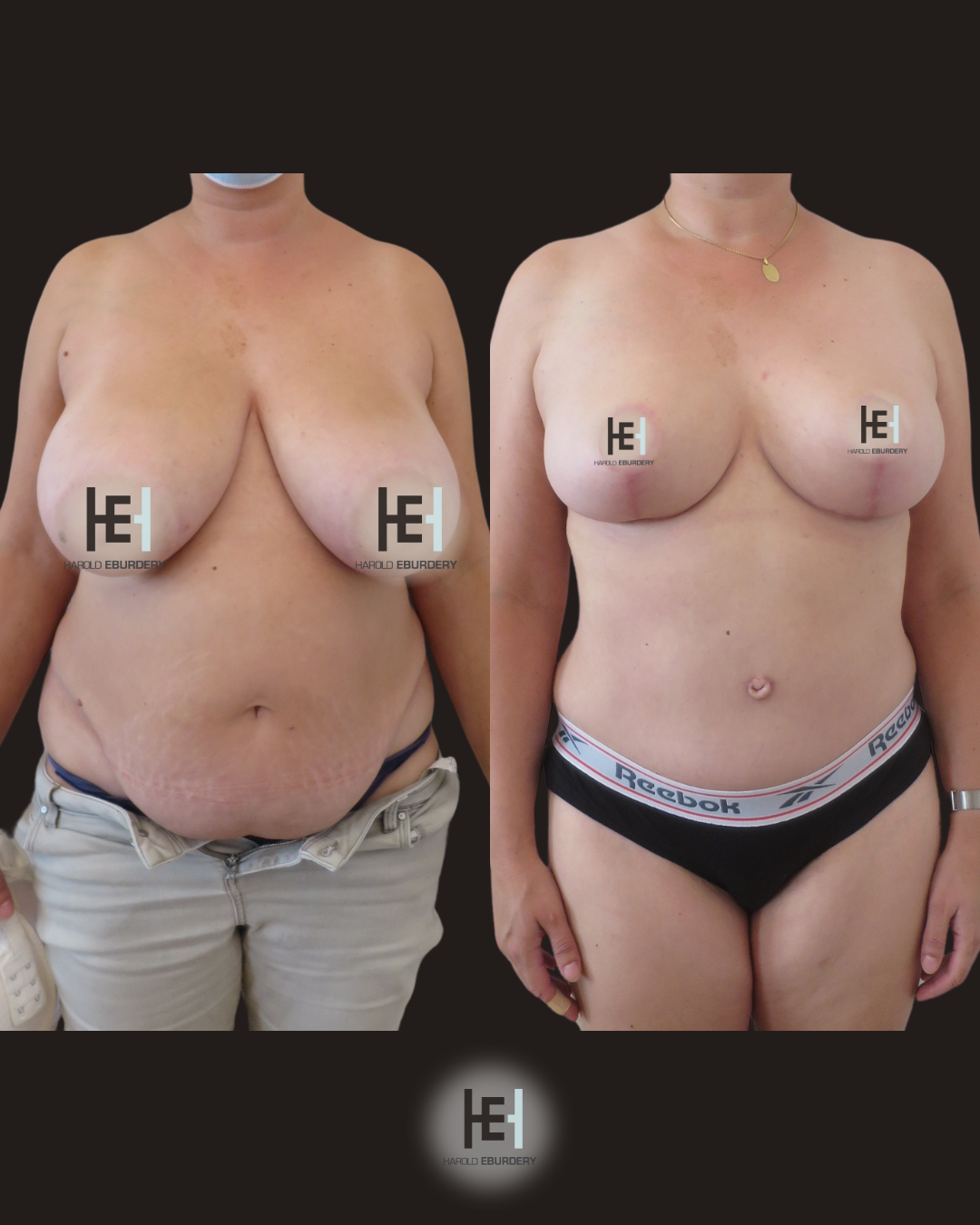 Photos avant / apres - abdominoplastie