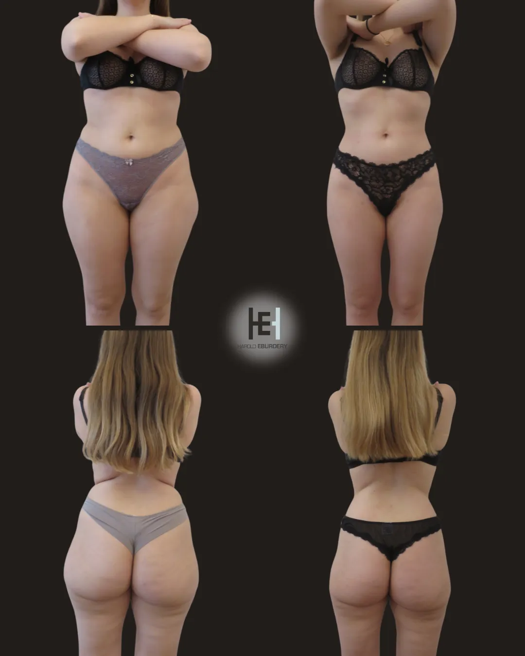 liposuccion - Patient 1