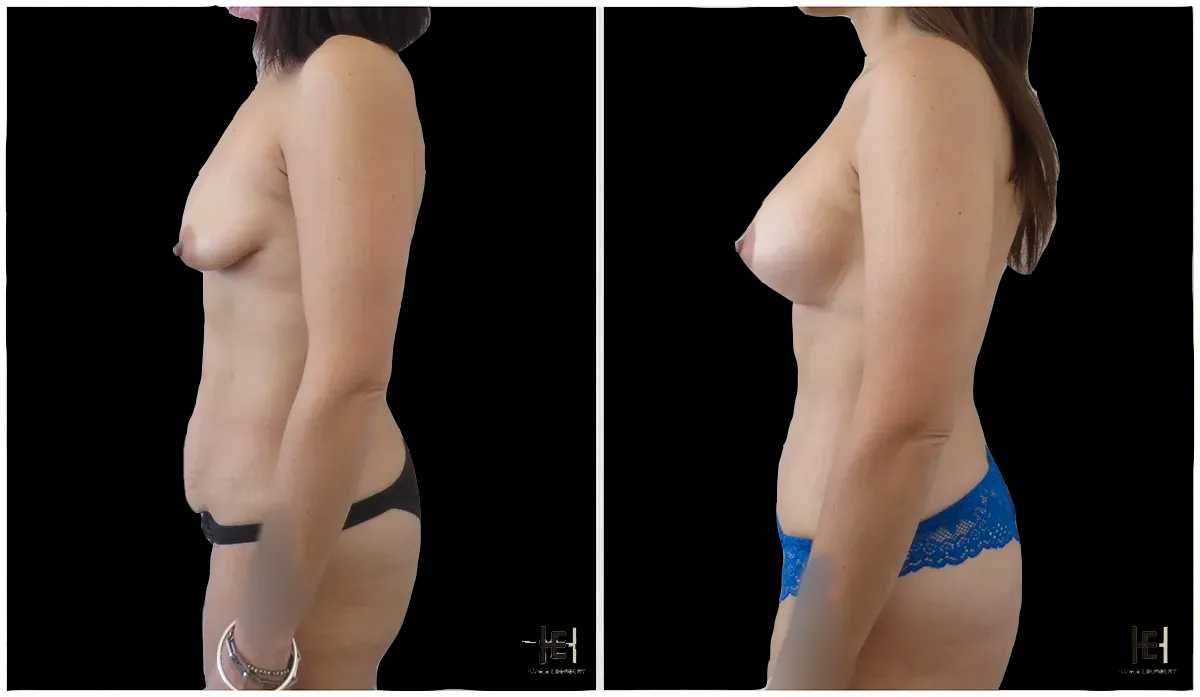 mommy makeover - Patient 3 profil