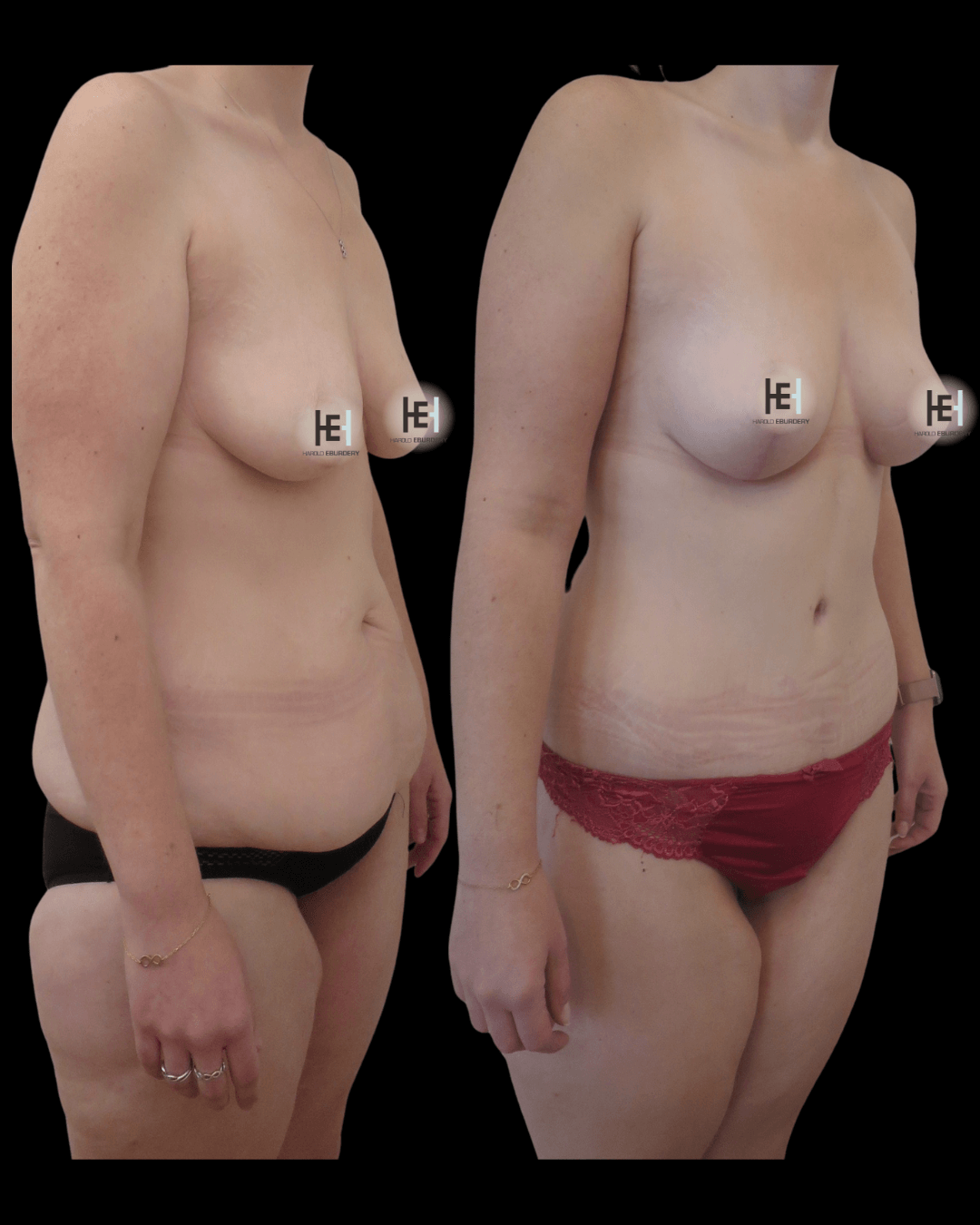 Photos - mommy makeover - Patient 2 trois-quart