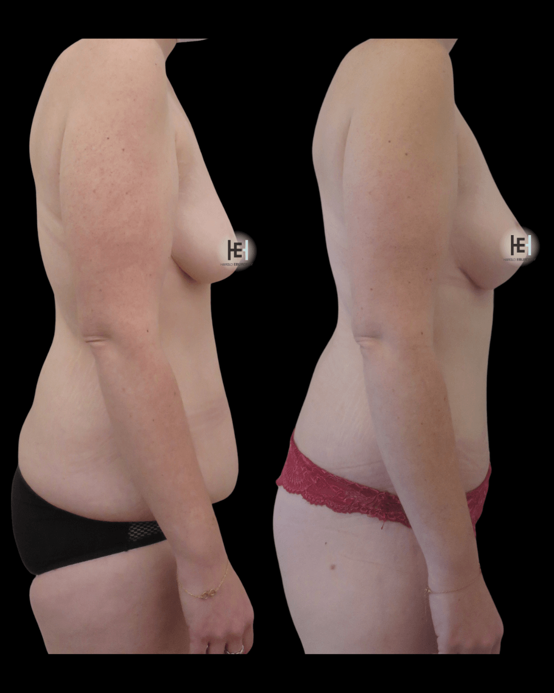 Photos - mommy makeover - Patient 2 profil