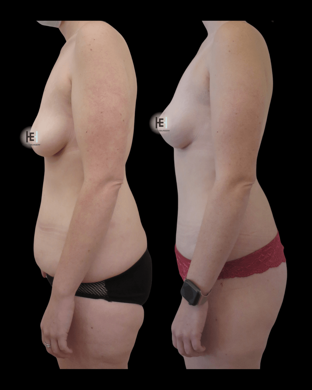 Photos - mommy makeover - Patient 2 profil