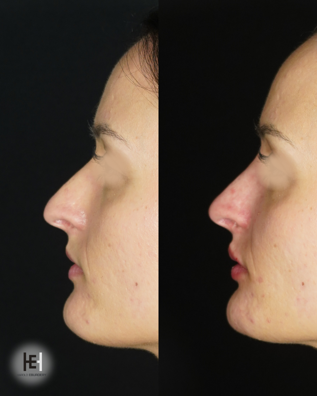 Profiloplastie médicale - Patient 1 profil