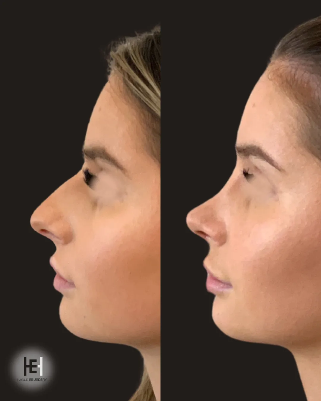 Rhinoplastie - Patiente 1