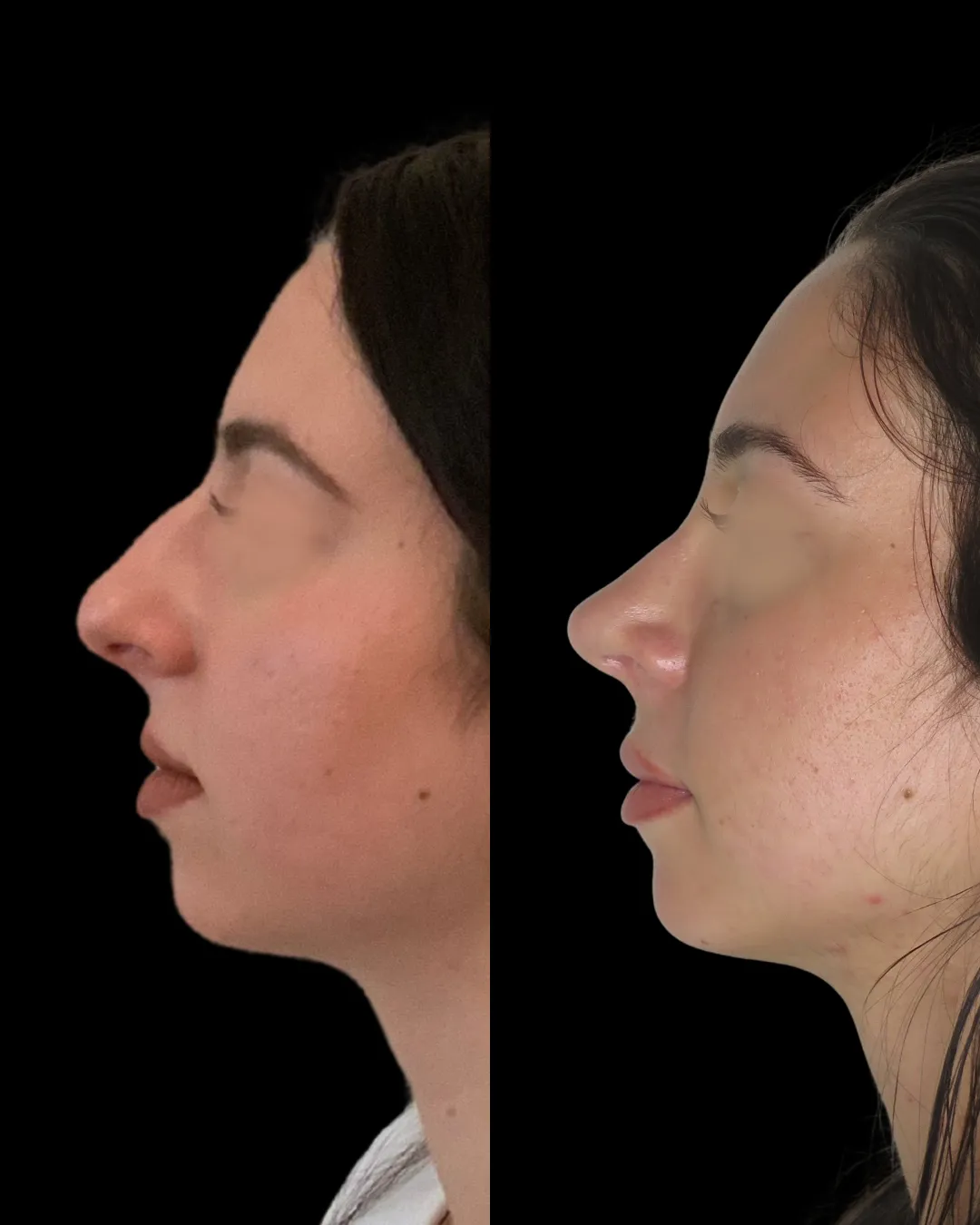 Rhinoplastie préservation - Patiente 2 profil