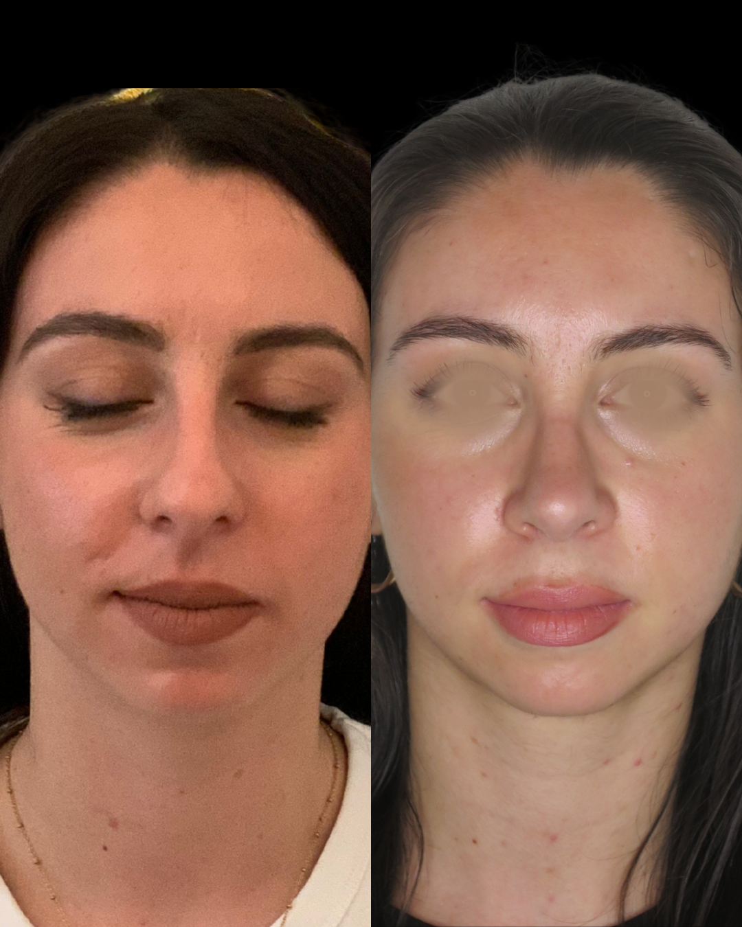 Rhinoplastie préservation - Patiente 2 face