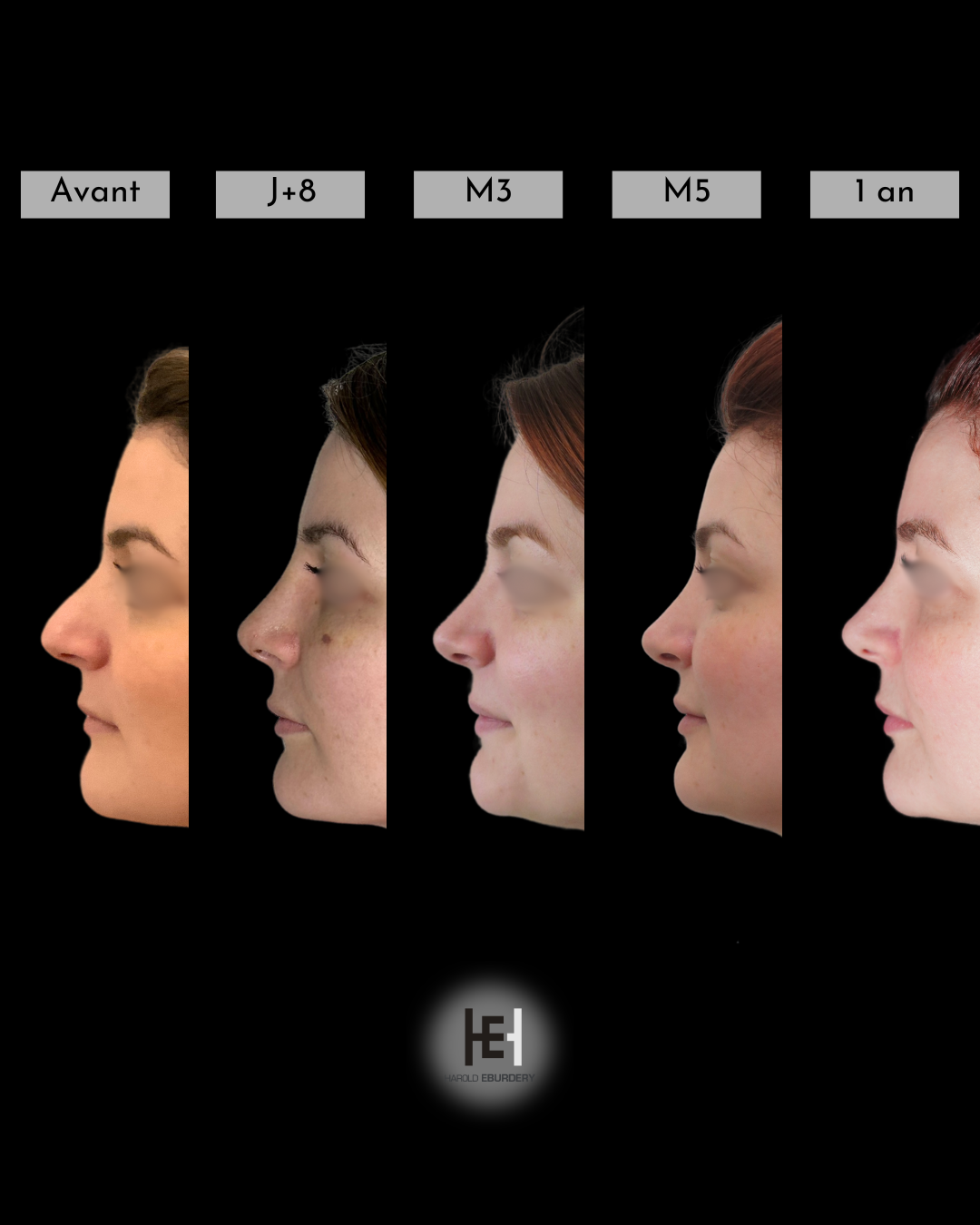 Evolution et suites opératoires de la rhinoplastie