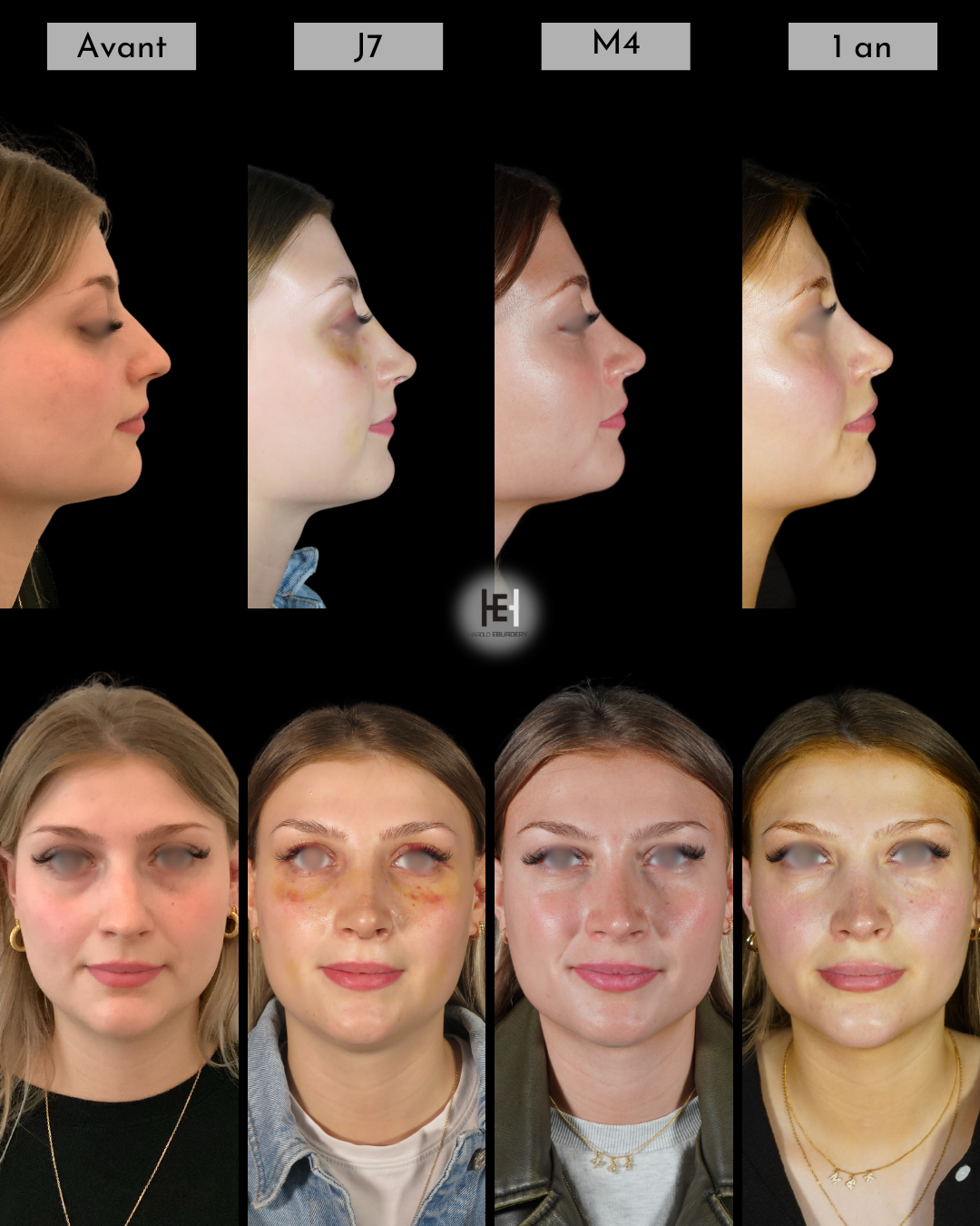 Evolution et suites opératoires de la rhinoplastie
