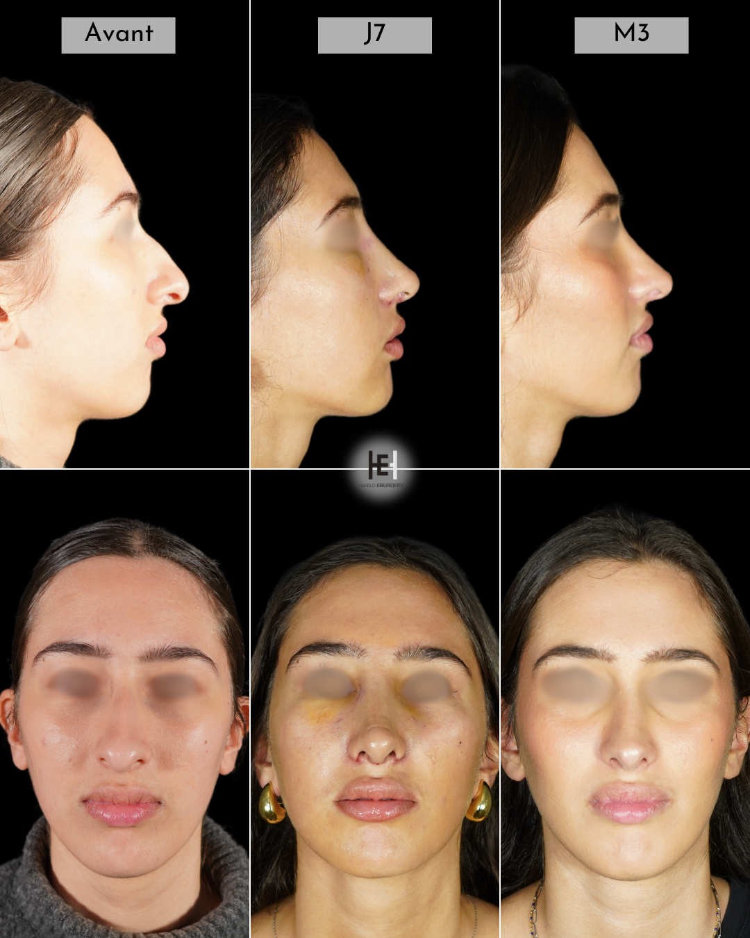Evolution et suites opératoires de la rhinoplastie