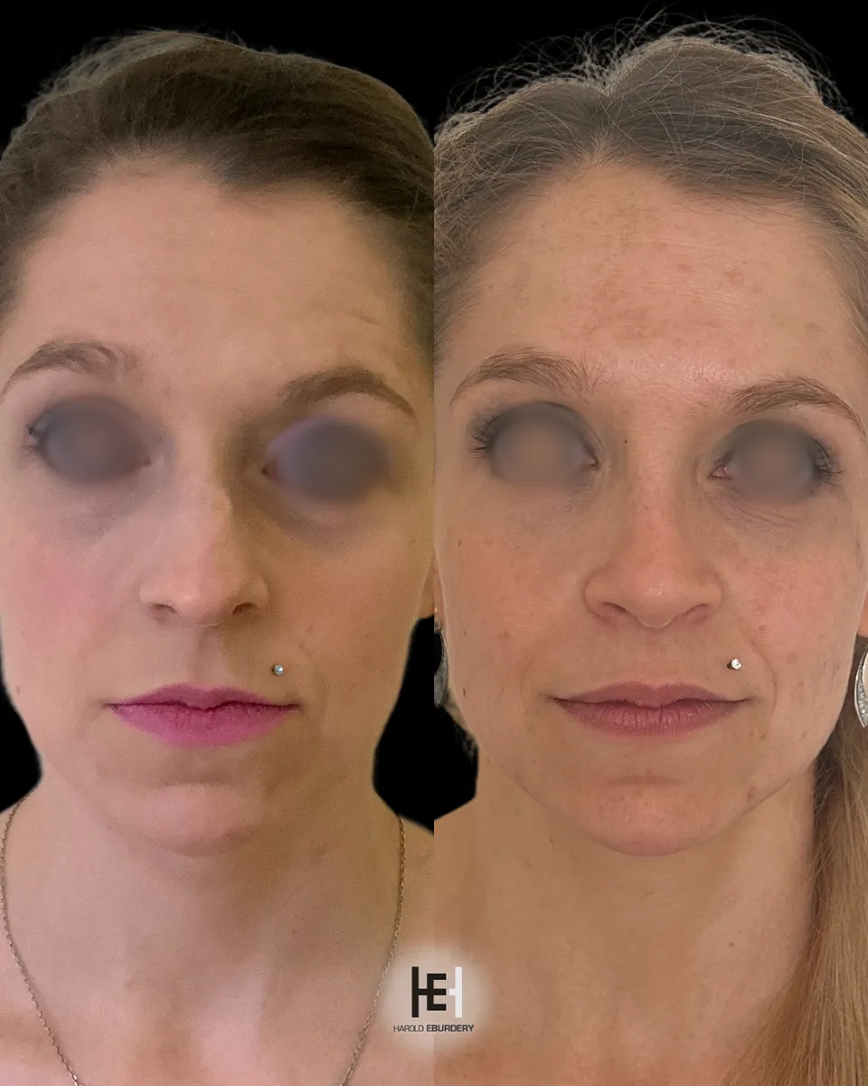Photos - Rhinoplastie - Patiente 4 face