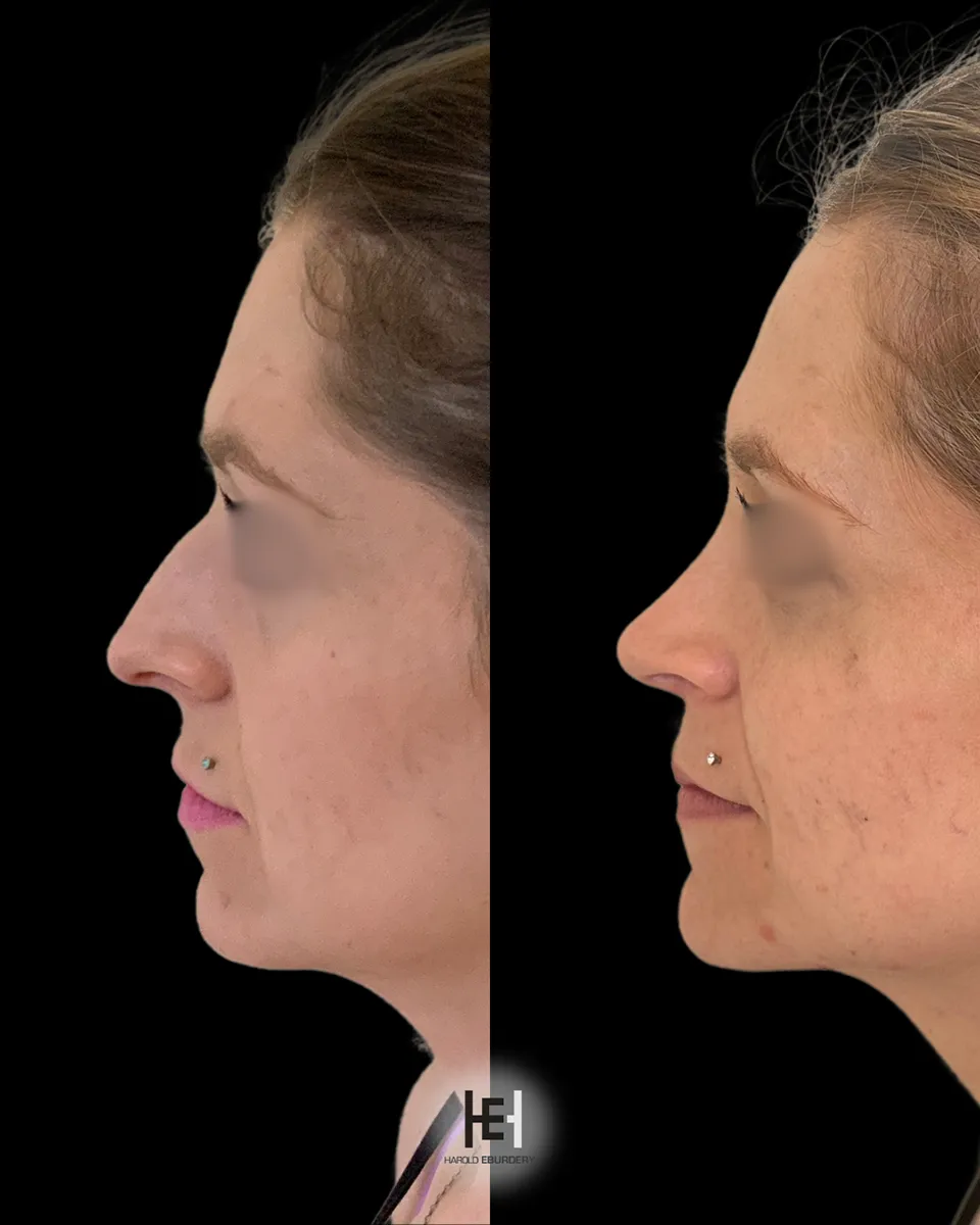 Photos - Rhinoplastie - Patiente 4 profil