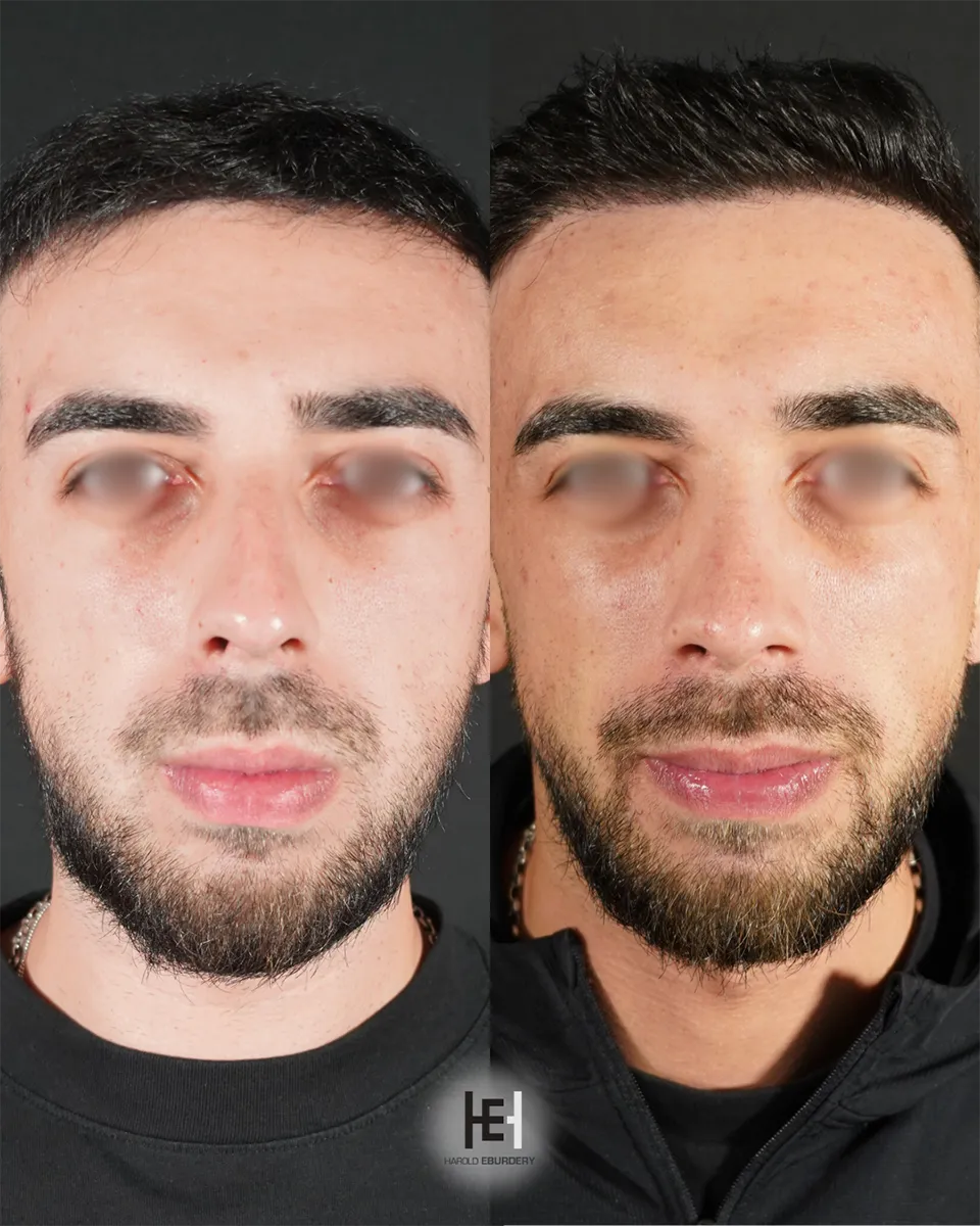Photos - Rhinoplastie - Patiente 6 face
