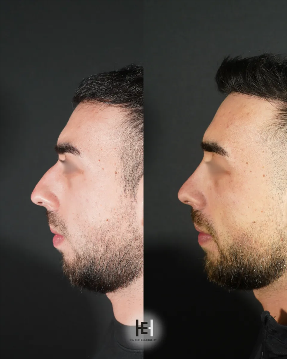 Photos - Rhinoplastie - Patiente  6 profil