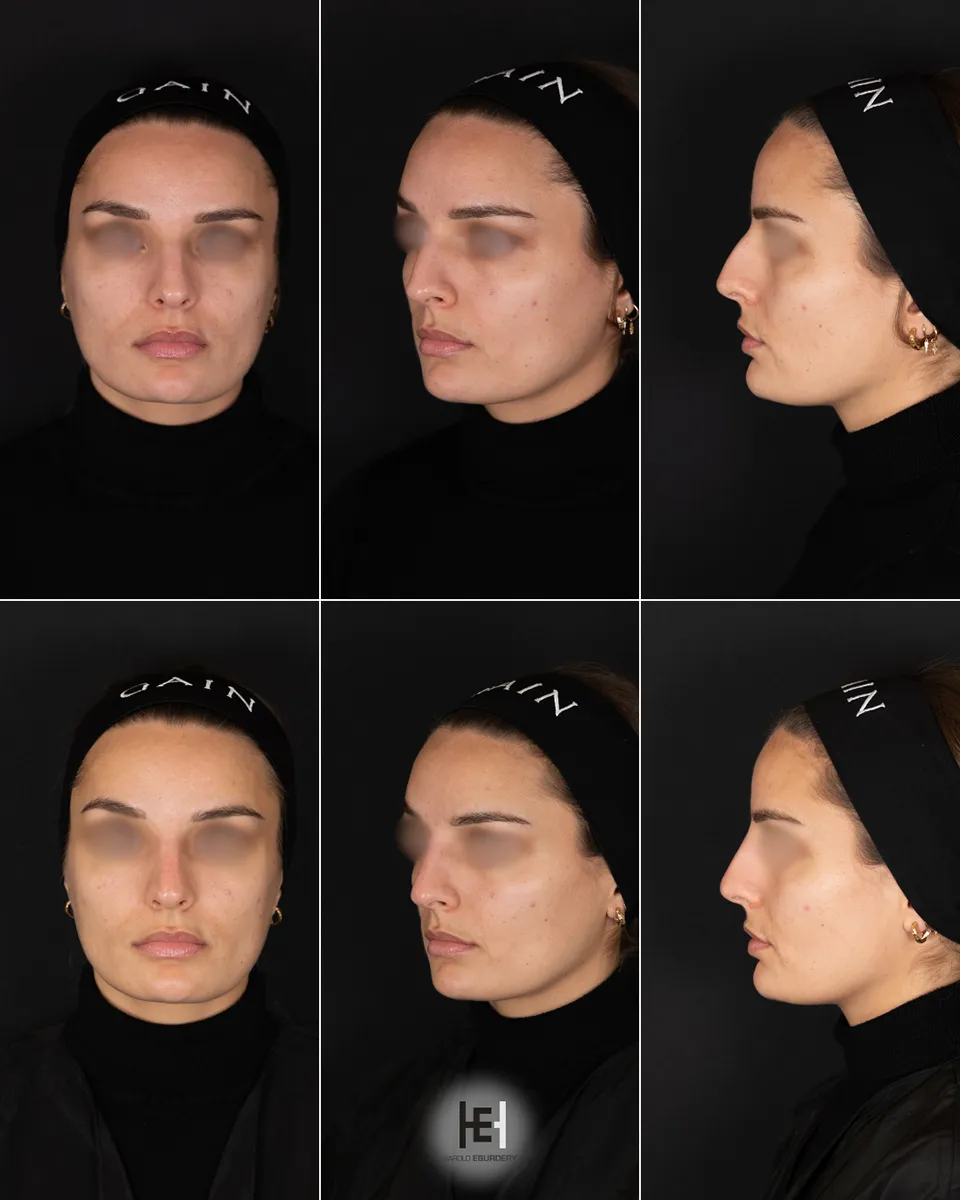 Rhinoplastie médicale - Patiente 7