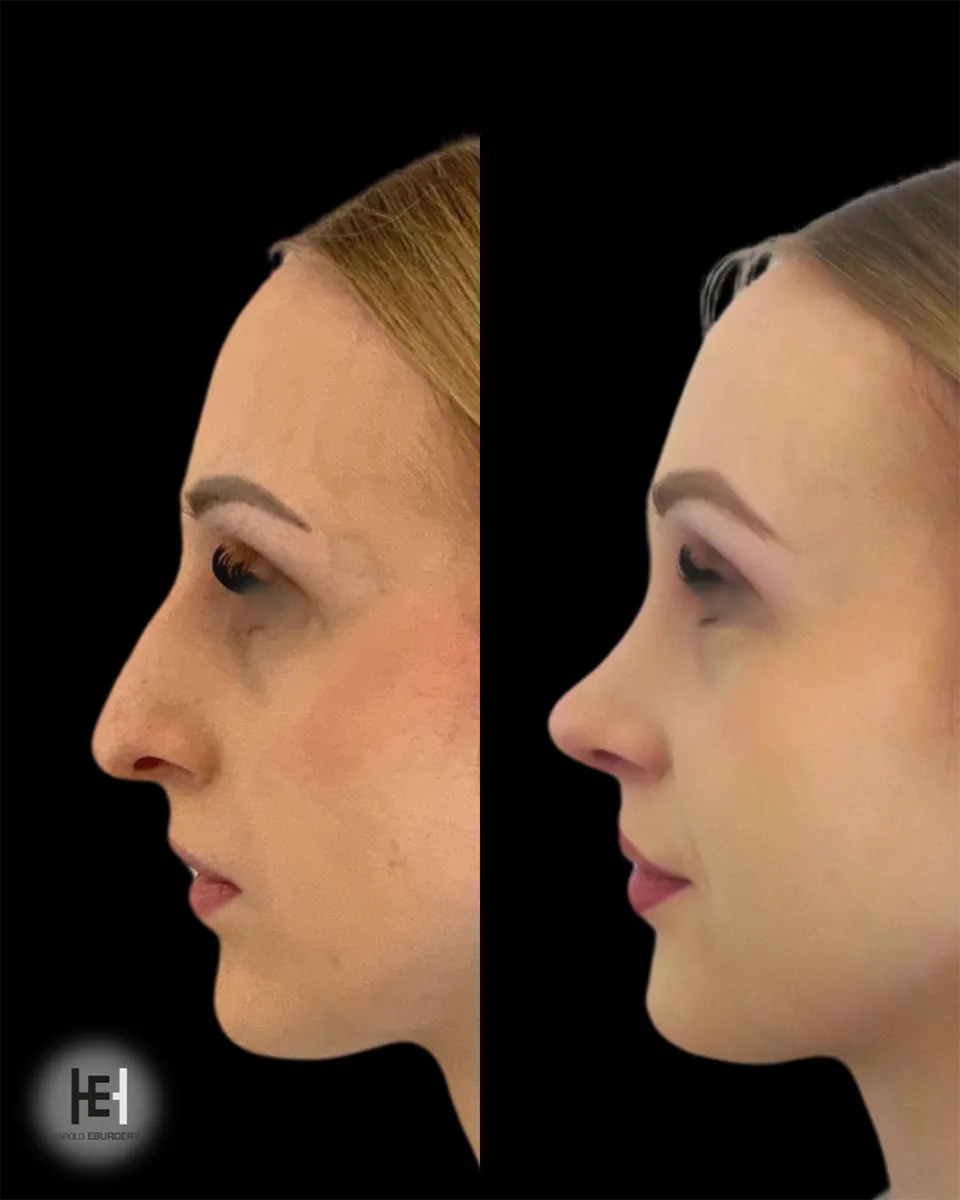 Rhinoplastie préservation - Patiente 3 profil