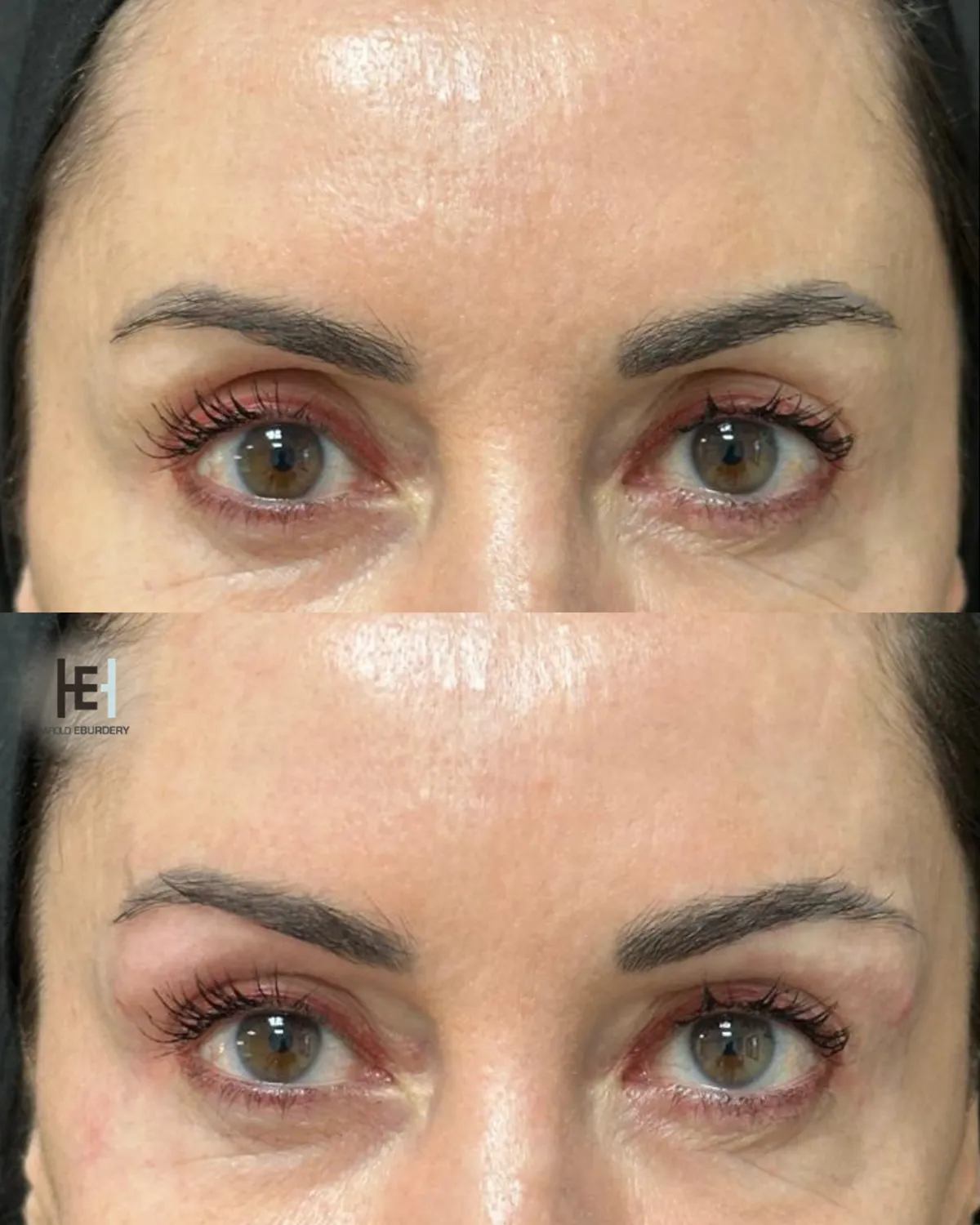 Comparatif Avant/Apr&egrave;s bl&eacute;pharoplastie paupi&egrave;res creuses &agrave; Lyon