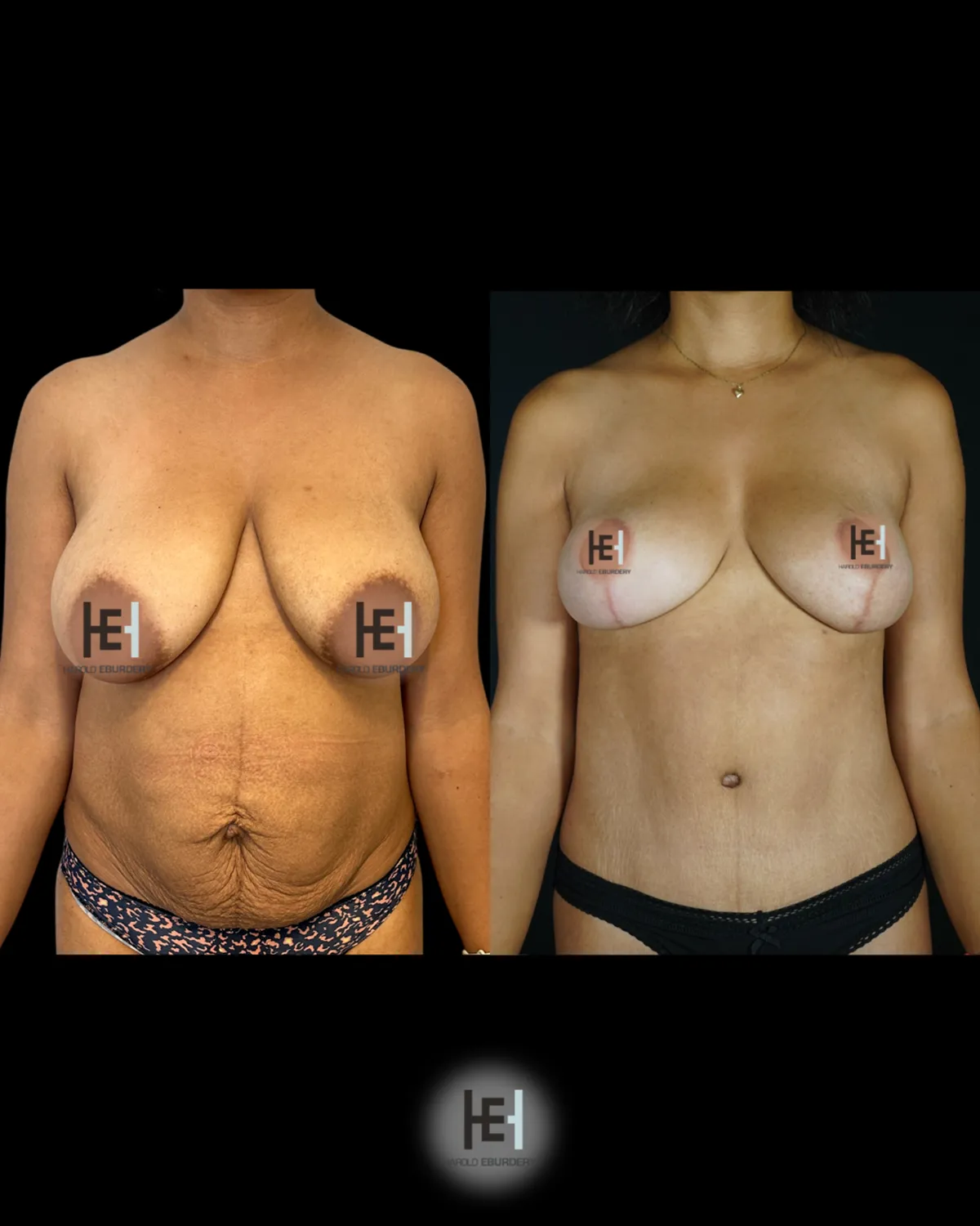 Comparatif Avant/Apr&egrave;s Mommy Makeover &agrave; Lyon