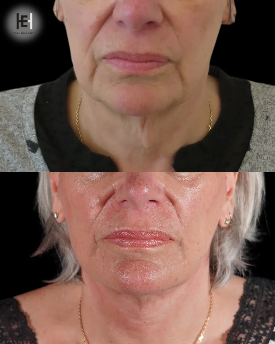 Avant/Après une intervention de Lifting cervico-facial, Vue de face