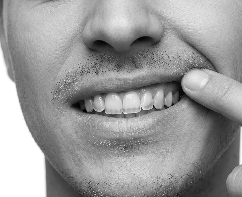 Apr&egrave;s lip lift