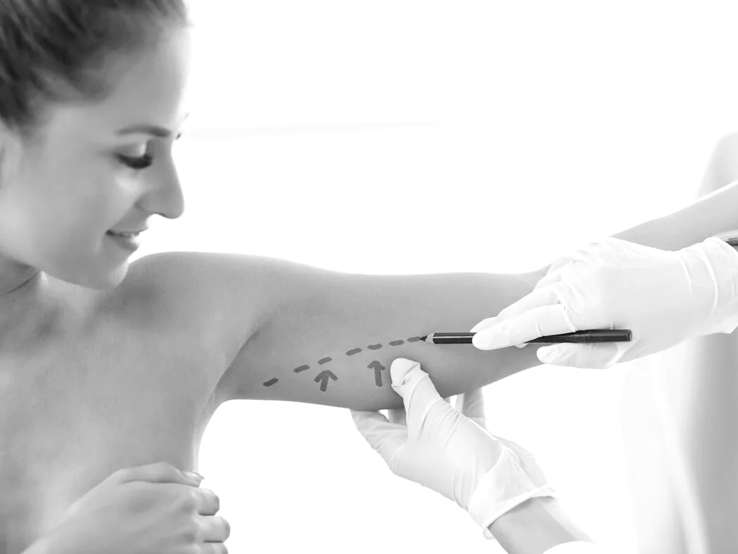 Brachioplastie