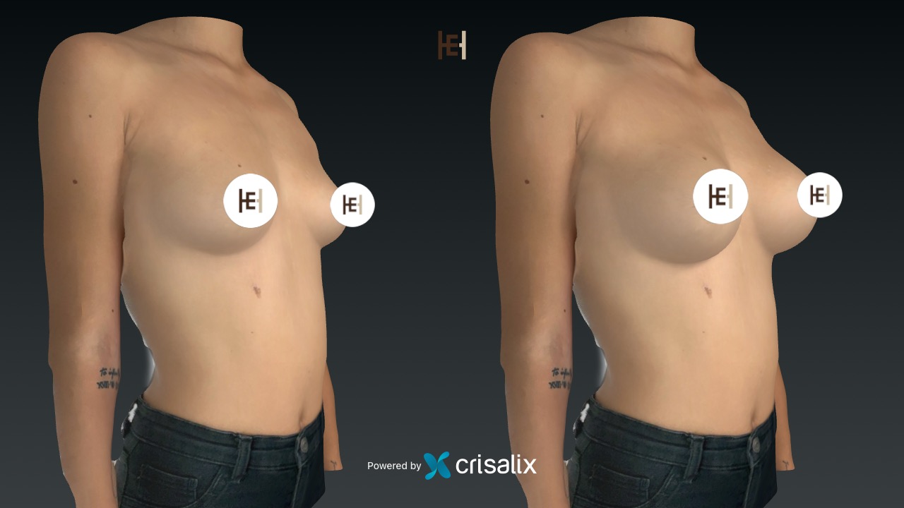 Crisalix simulation 3d