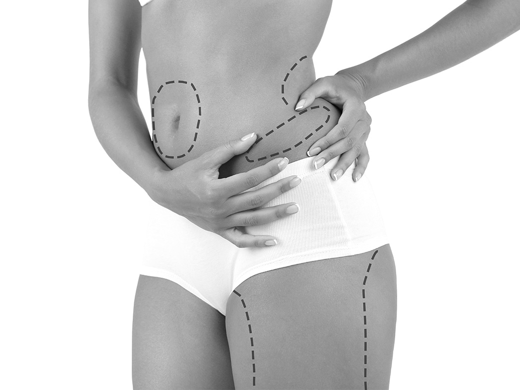 Liposuccion