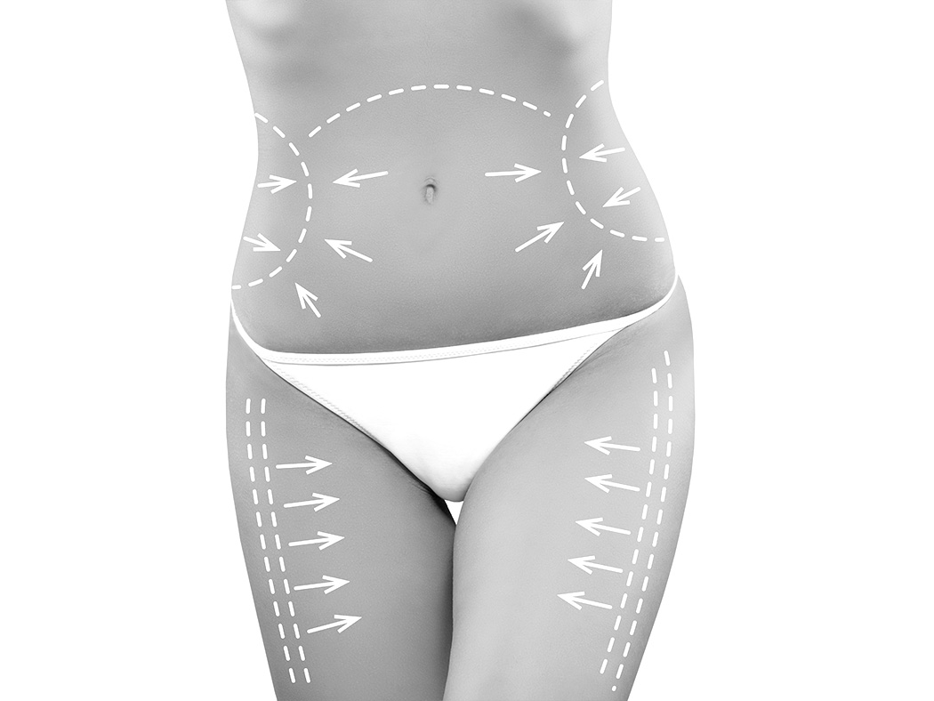 Lipofilling