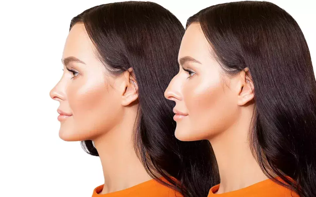 Enlever une bosse du nez : quelles solutions selon les cas ?