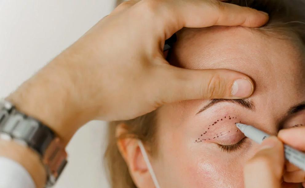 deroulement blepharoplastie
