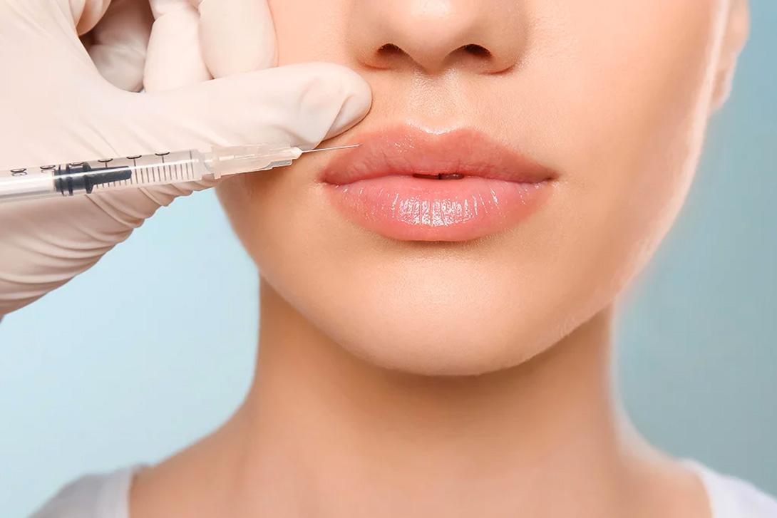 Injections pour les lèvres