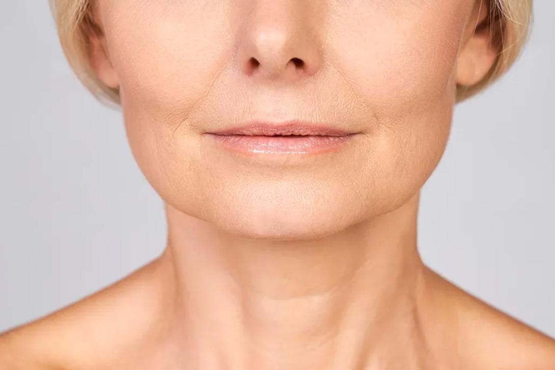Lifting du visage