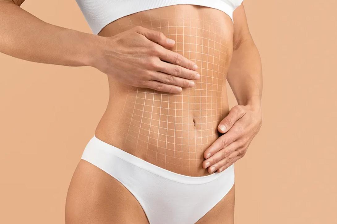 Abdominoplastie : Convalescence et Résultats