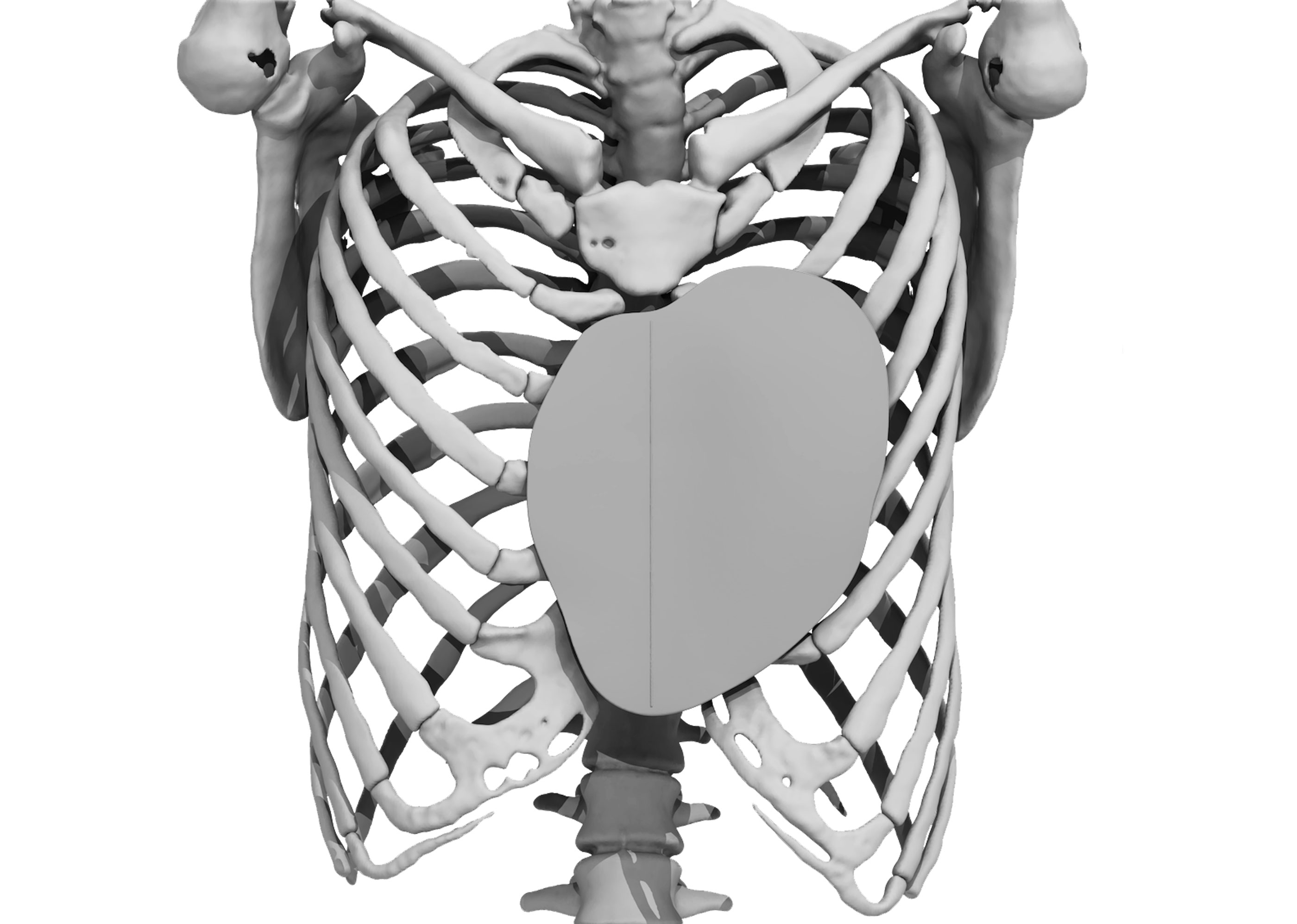 chirurgie pectus excavatum