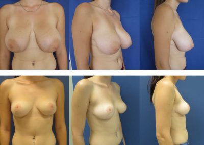 diminution des seins avant après sur femme de 19 ans